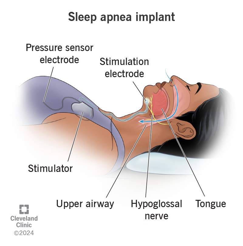 Inspire Sleep Apnea Implant Diagram showing device placement