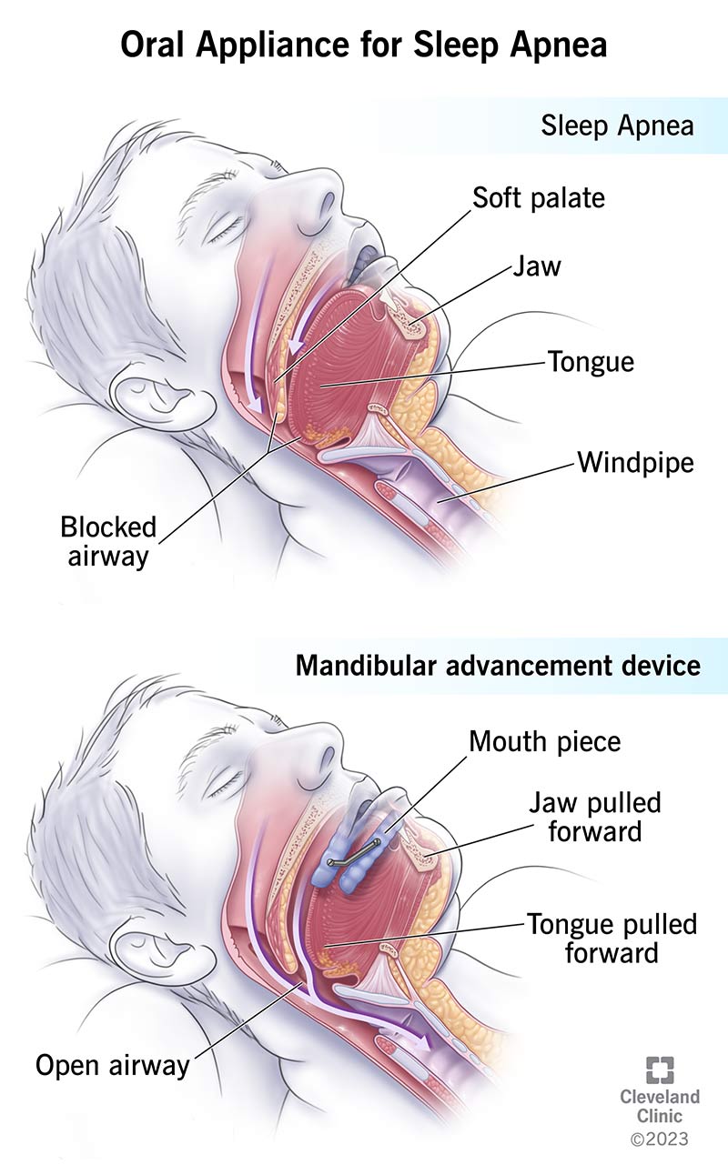 Oral Appliance Diagram