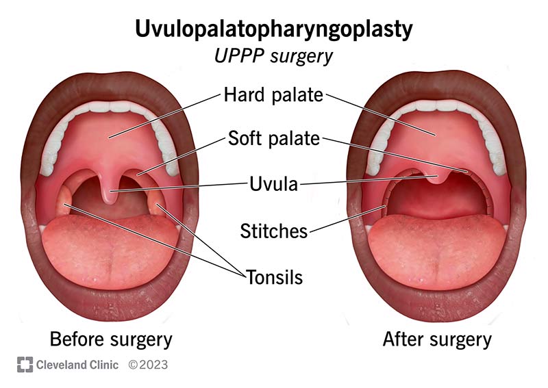 UPPP Surgery Diagram